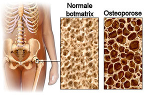  Osteoporose of botontkalking